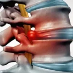 Spinal infection illustration with inflamed disc pressing on spinal cord.