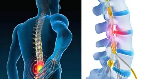 Early Signs of Cervical & Lumbar Spondylosis You Shouldn’t Ignore