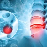 What is a Spinal Tumor? Symptoms, Causes, and Treatment