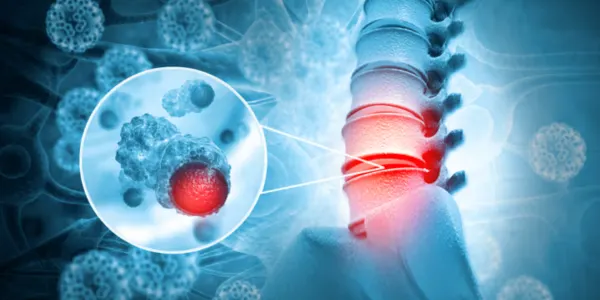 What is a Spinal Tumor? Symptoms, Causes, and Treatment