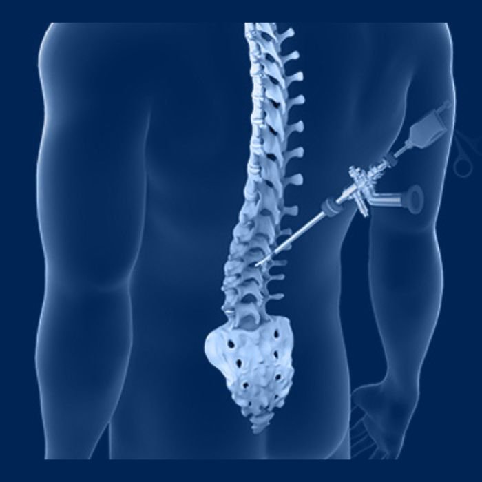 MIS-Spine