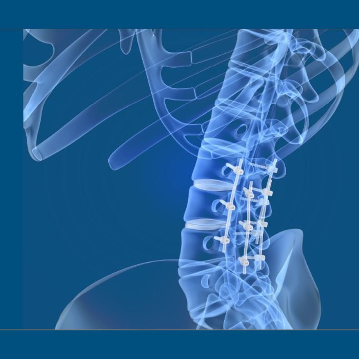 Spine-Fixation-For-Fractures